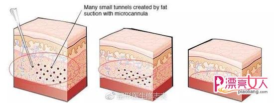 吸脂后保留一定厚度脂肪