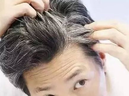 白发真的拔一根会长十根吗？如何预防白发(图2)