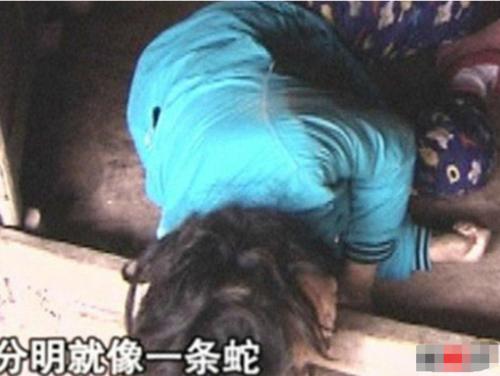 13岁少女发烧后变蛇娃 医生无解(图2)