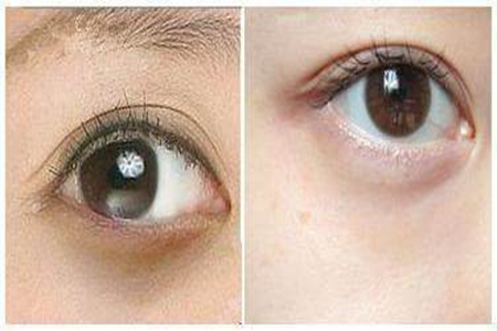 如何巧妙去除黑眼圈？六个简单方法帮你轻松去除黑眼圈(图2)
