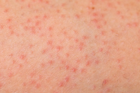 秋季皮肤病都有哪些？这五个秋季皮肤病做好应对措施(图1)