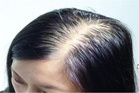 脱发的原因有哪些，这些导致脱发的原因女性要尤为重视(图2)