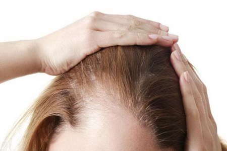 一直脱发怎么办？女人大量脱发的4大原因(图2)