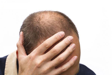 年轻人掉头发如何调理 遗传性脱发能治好吗？(图2)