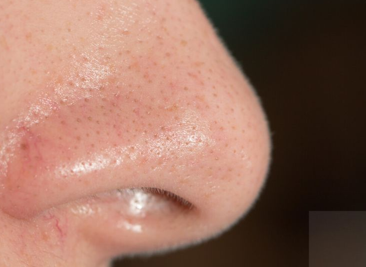 鼻子周围为什么容易出油？如何科学地去除鼻子上的黑头？(图3)