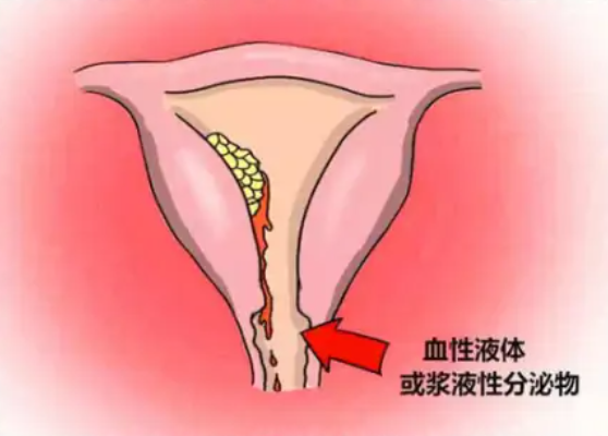 底裤是宫颈癌的“感应器”，底裤上若出现2种颜色，手洗时瞅两眼(图3)