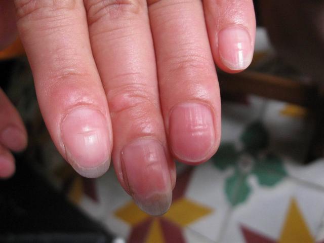 手指甲长出竖纹，是健康出问题了吗？也要考虑这3个原因(图6)