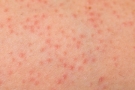 秋季皮肤病都有哪些？这五个秋季皮肤病做好应对措施