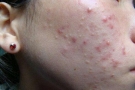 脸颊两边长痘痘是什么原因引起的？这五个左右脸颊起痘痘的原因