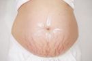 女人孕期如何预防与消除妊娠纹？这几点孕妇一定要做到