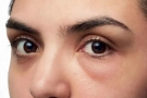眼皮浮肿是什么原因引起的，这三个女性上眼皮浮肿的原因